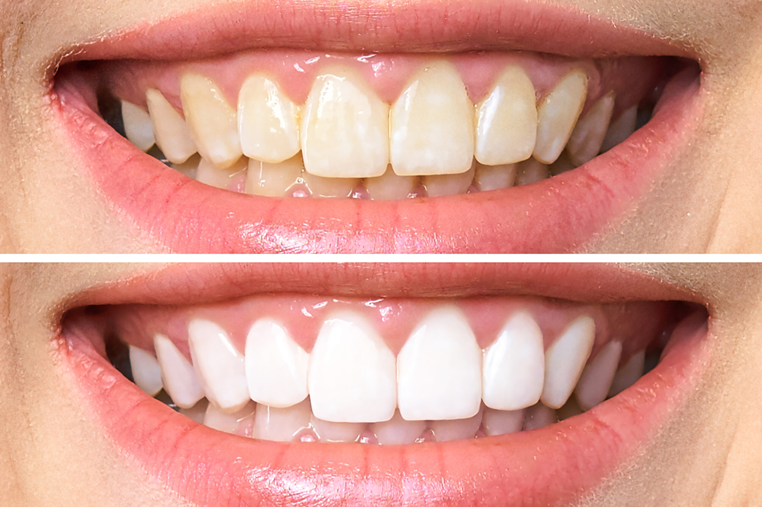 6. Отбеливание зубов